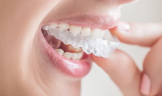 Clear Aligners | Ottawa Dentistry